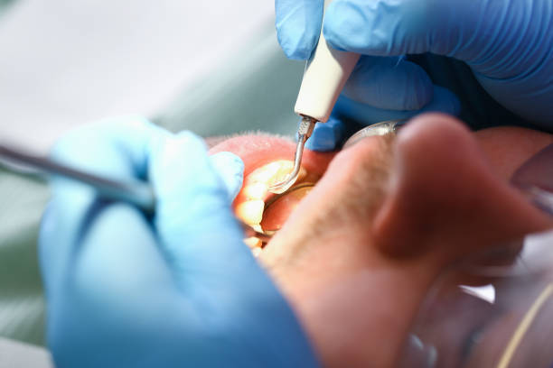 Best Emergency Dental Care for Broken or Chipped Teeth in Culloden, WV