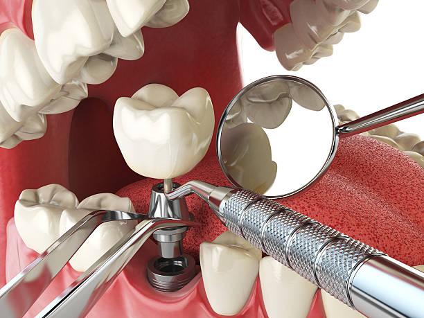 Best Emergency Dental Care for Broken or Chipped Teeth in Culloden, WV